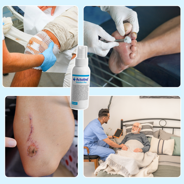 Actolind ® Solution Plus 50 ml | Yara Bakım Solüsyonu